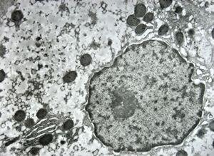 F,1y. | glycogenosis type II. (glycogen dissolved due to UA blockstaining) F,1y. | glycogenosis type II. (glycogen dissolved due to UA blockstaining)